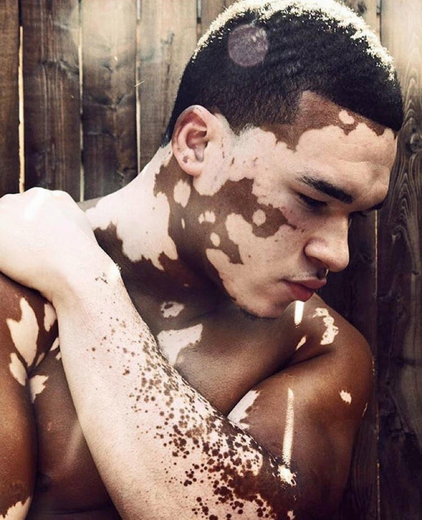 skin care for men with vitiligo 